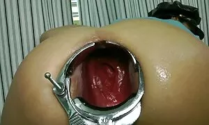 i-speculum prolapse  ...